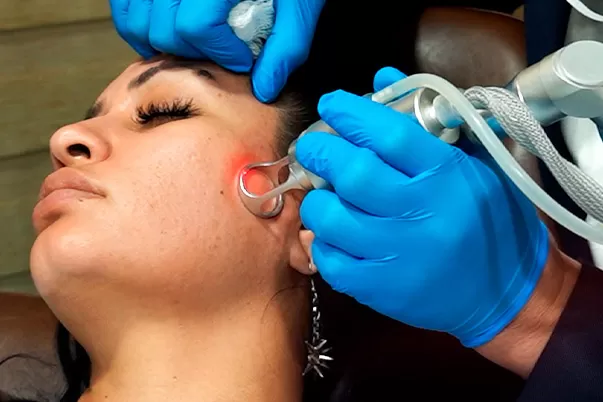 Tratamiento de eliminación de tatuajes con láser en Vive Spa Médico