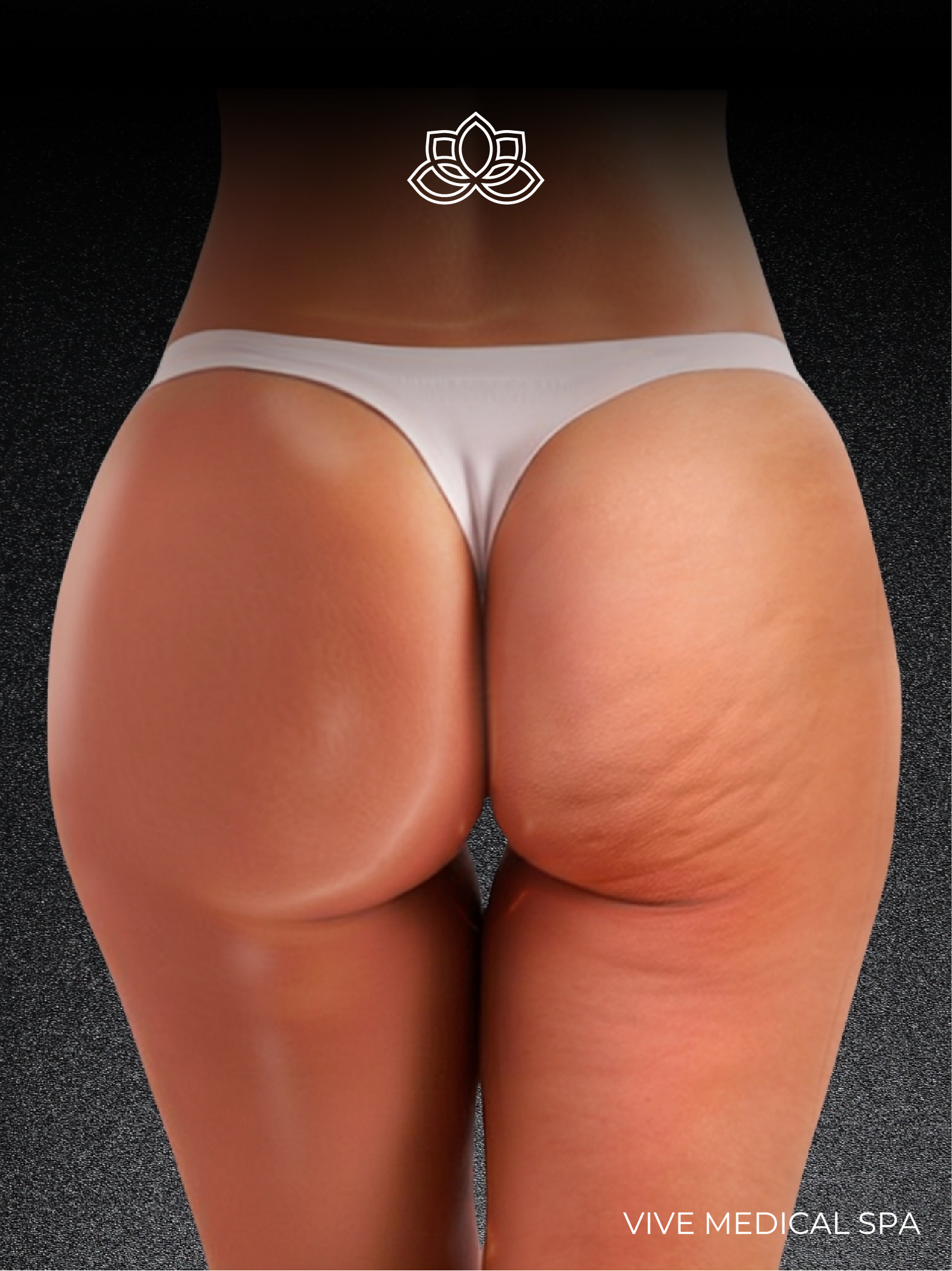 Lanluma XL treatment at Vive Med Spa Tijuana, Mexico - poly-L-lactic acid collagen stimulation