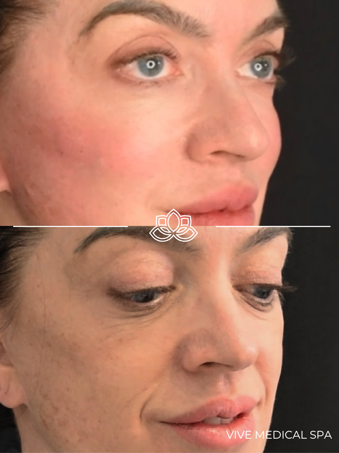 Tratamiento de relleno de mejillas en Vive Med Spa