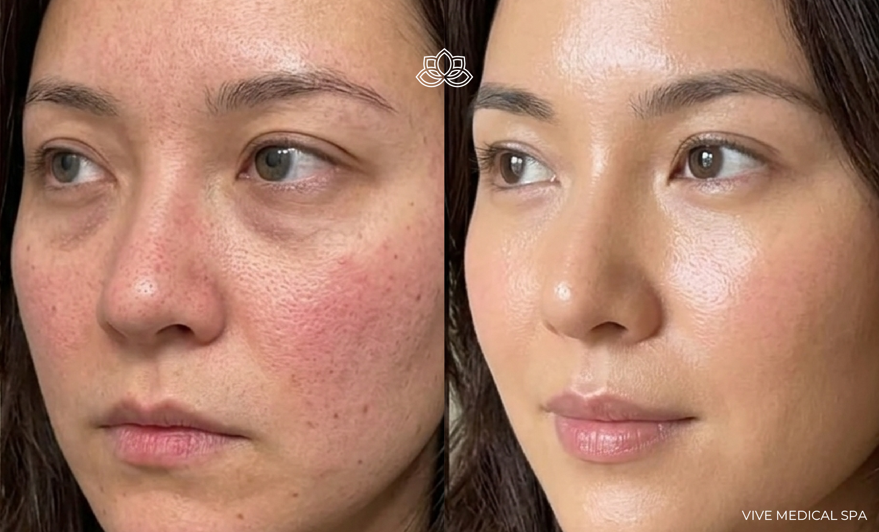 Procedimiento de relleno de mejillas en Vive Med Spa Tijuana