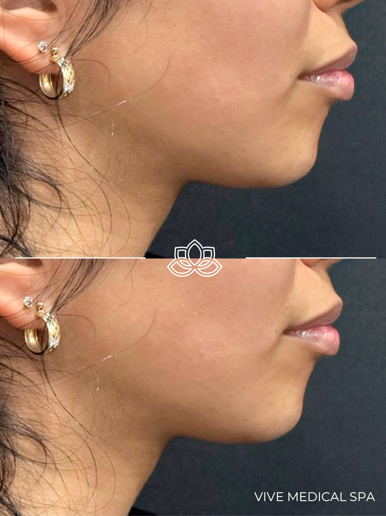 Tratamiento de relleno de mentón en Vive Med Spa Tijuana