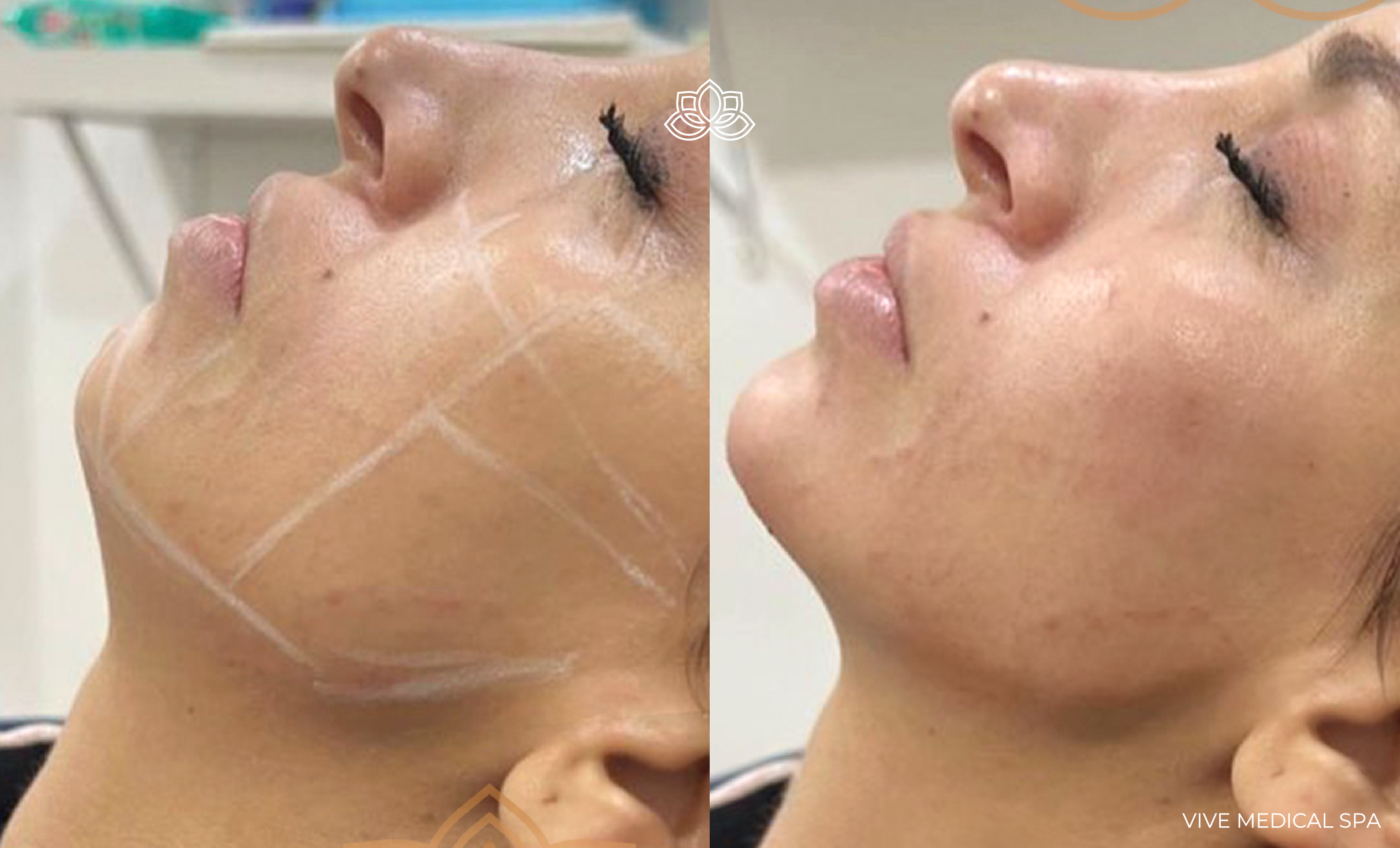 Procedimiento de aumento de mentón en Vive Med Spa Tijuana