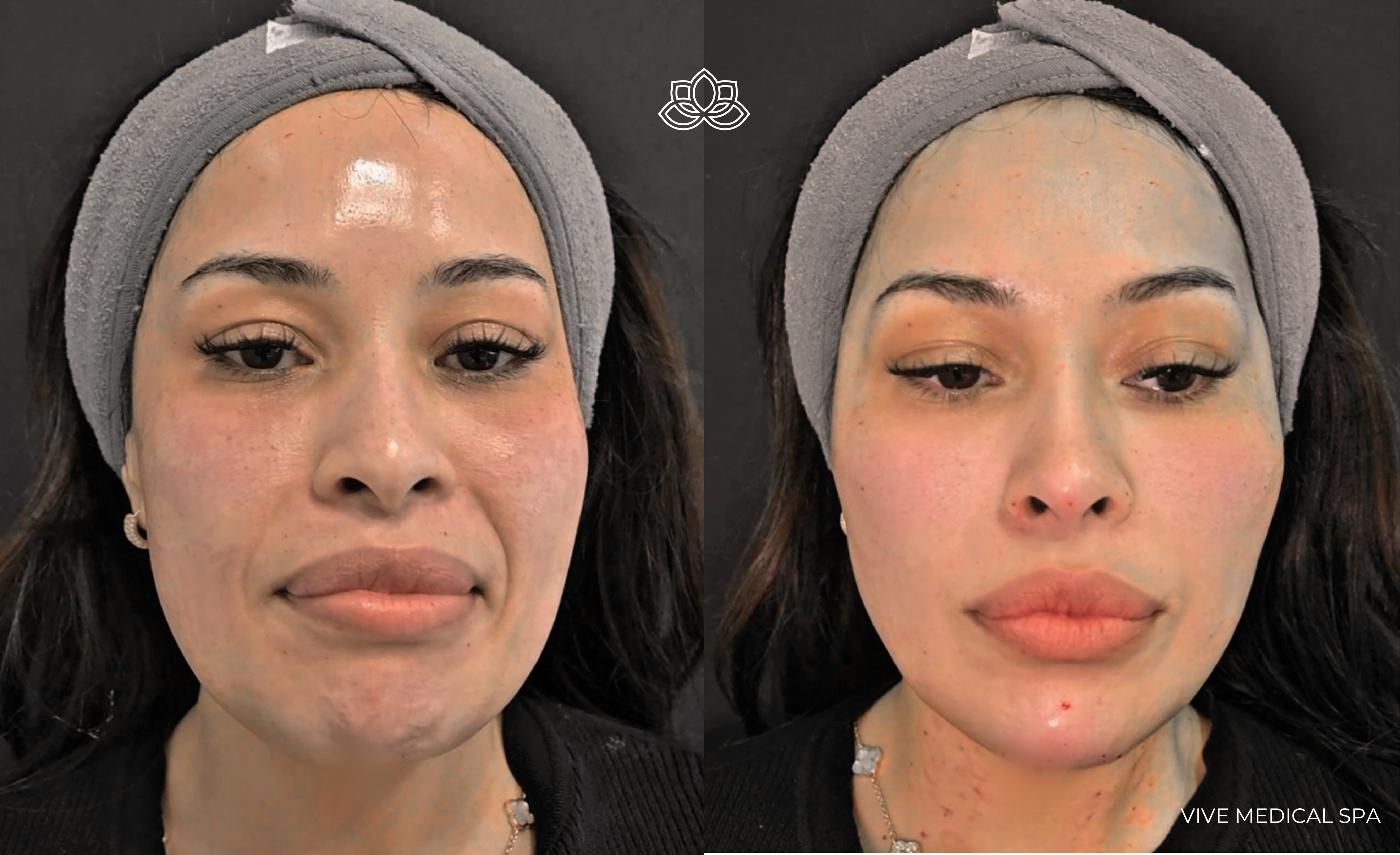 Imagen clínica de radiofrecuencia 3DEEP de Endymed en Vive Spa Médico