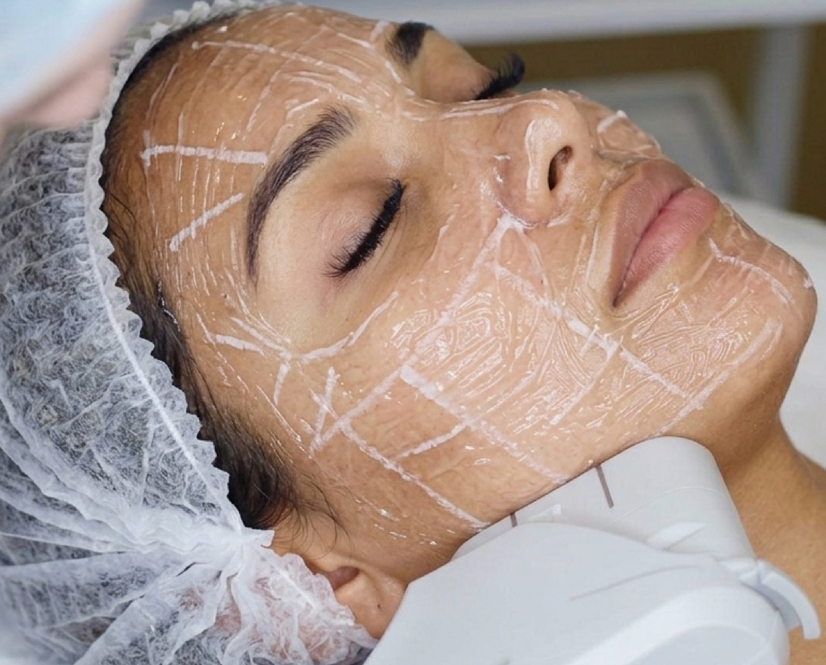 Resultados del tratamiento de ultrasonido HIFU en Vive Medical Spa Tijuana