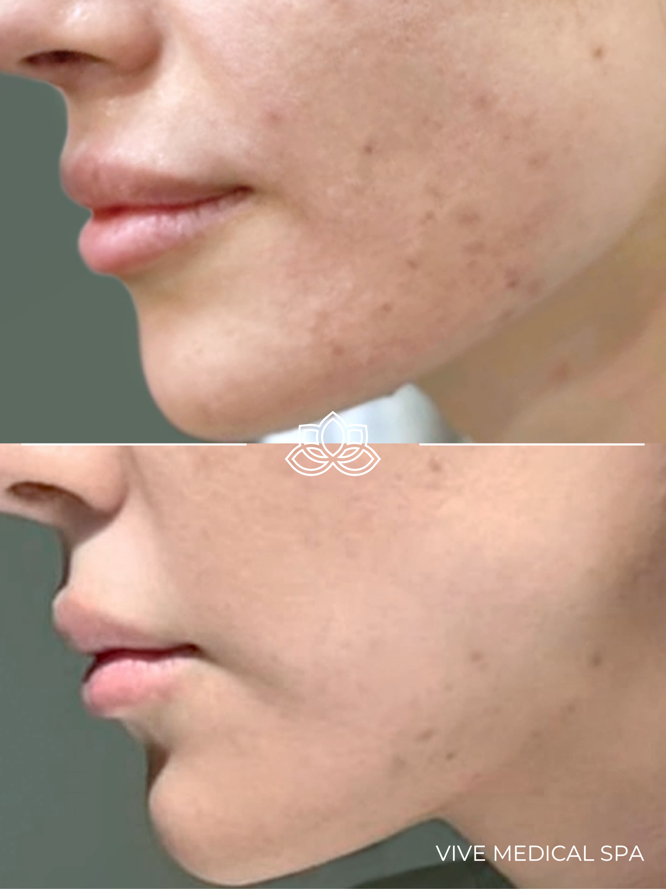 Tratamiento inyectable con Kybella: reducción de grasa con ácido desoxicólico