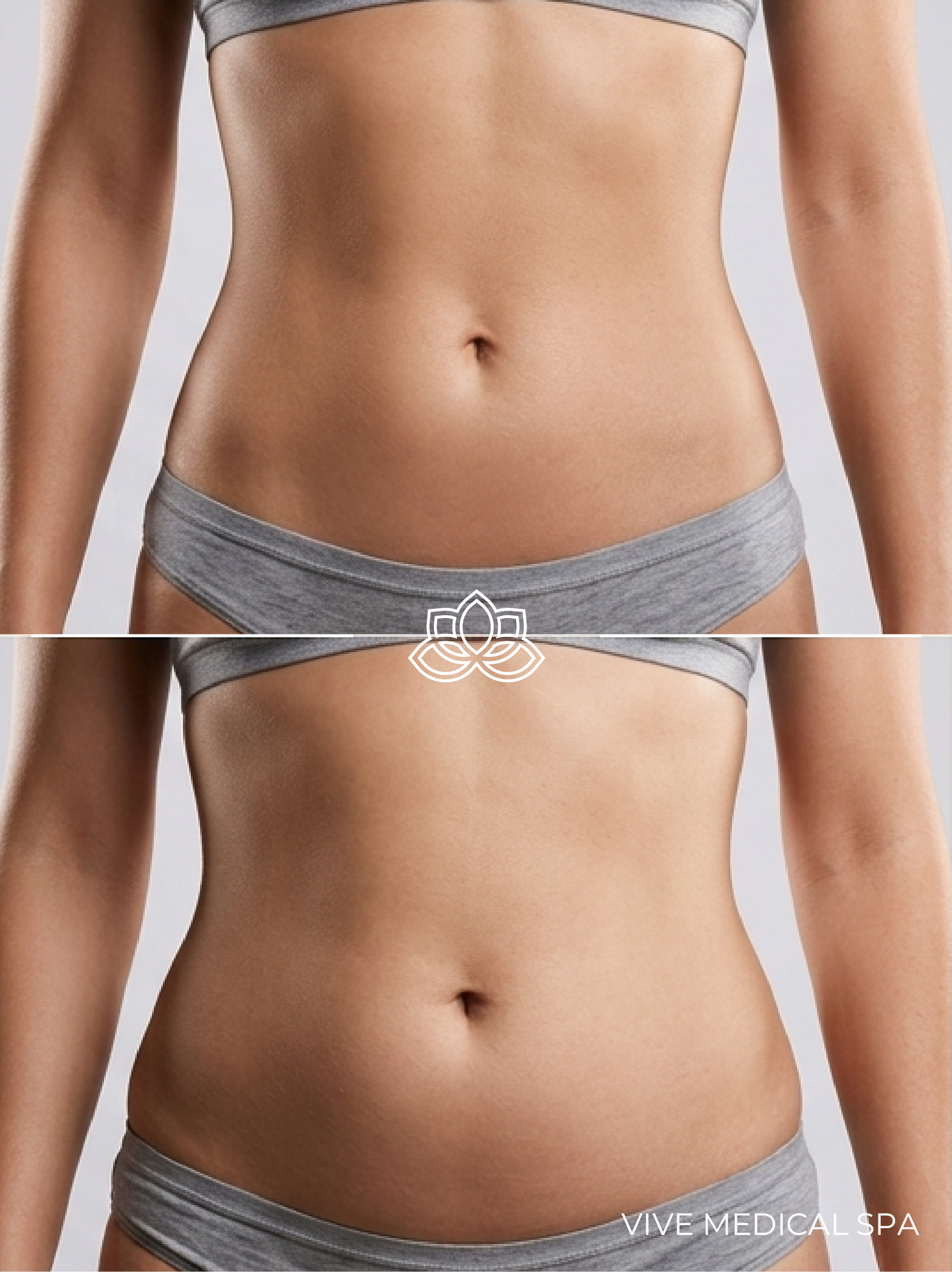 Tratamiento Liposonix - Contorneado corporal HIFU en Vive Med Spa