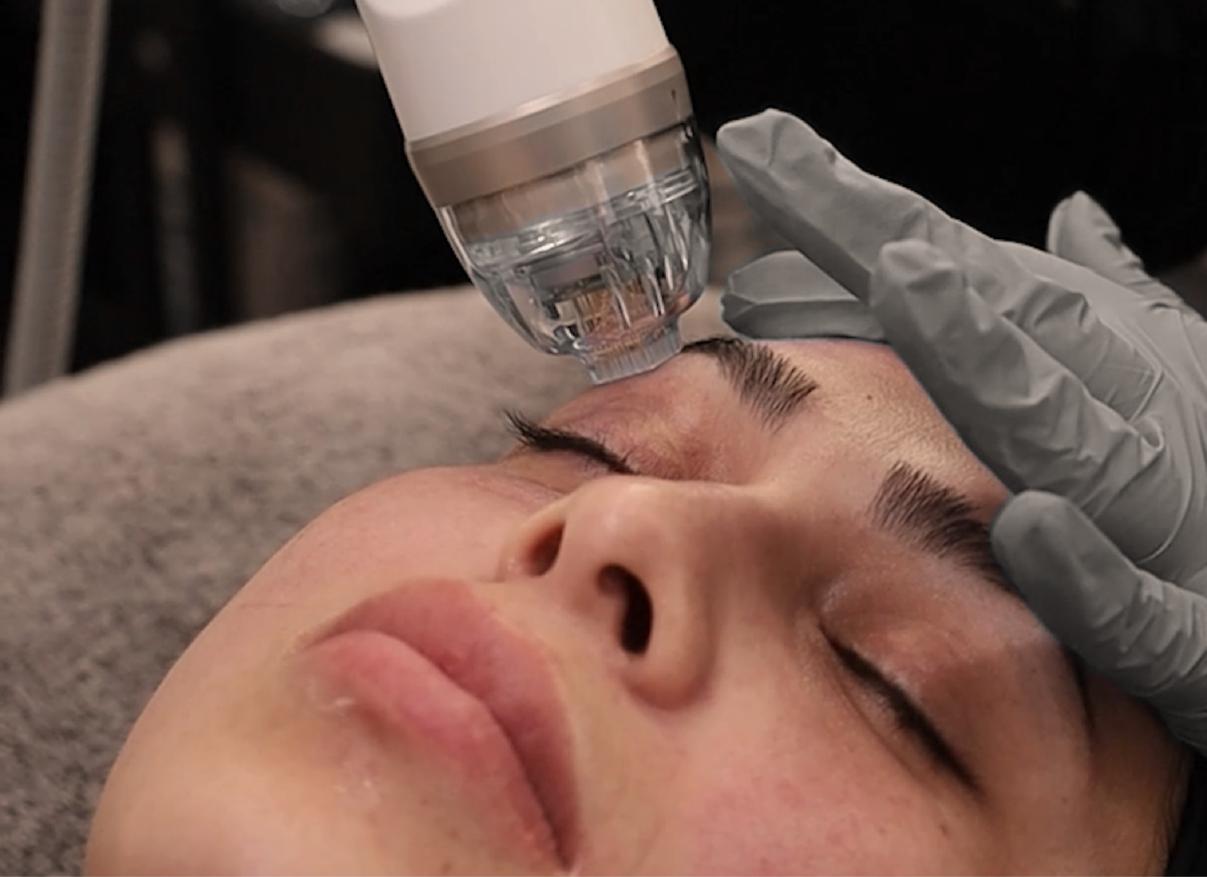 Vive Med Spa - Sala de tratamiento de Microneedling con RF
