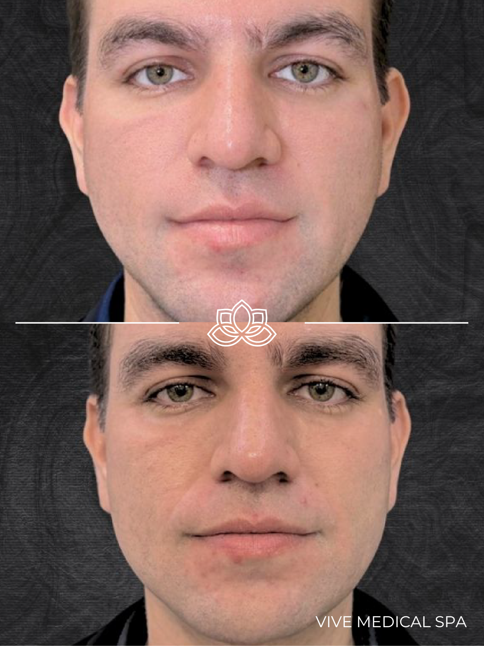 Resultados de microneedling con radiofrecuencia Morpheus8