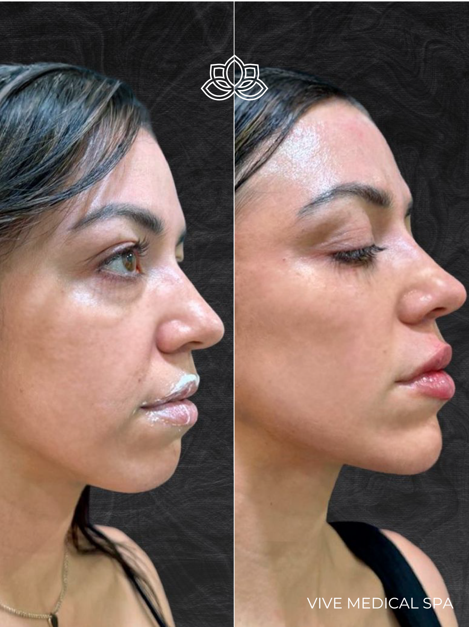 Tratamiento con Sculptra en Vive Medical Spa: estimulación de colágeno para rejuvenecimiento facial