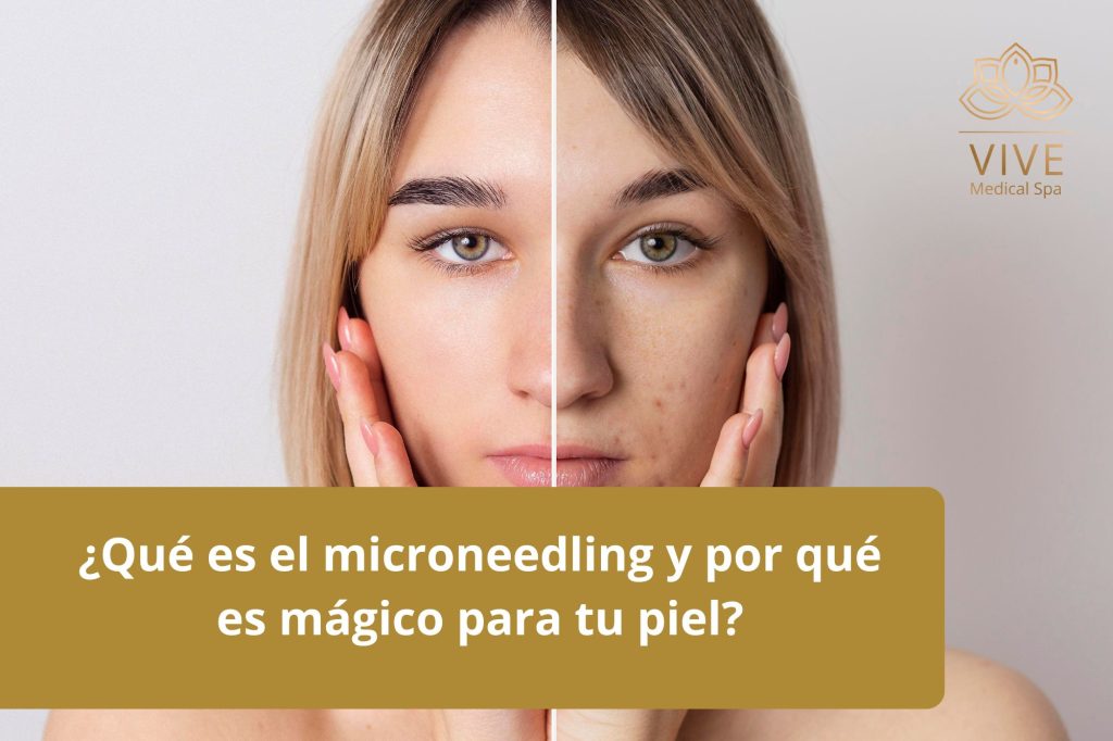 Antes y después del microneedling blog VIVE Medical Spa Tijuana, mejora visible de textura y manchas en la piel