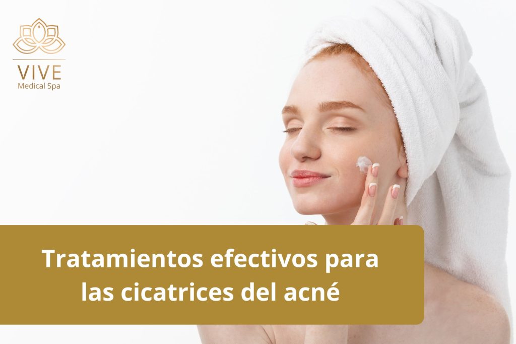 Tratamientos efectivos para cicatrices de acné en VIVE Medical Spa - Rejuvenecimiento facial en Tijuana