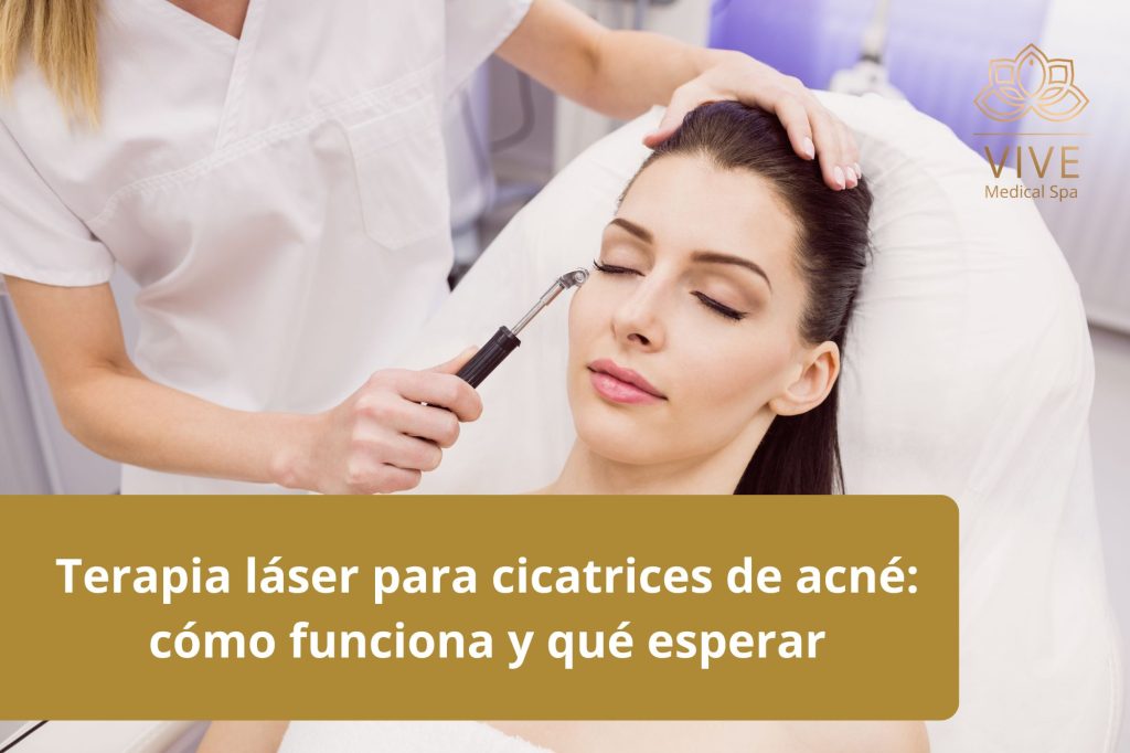 Terapia láser para cicatrices de acné en VIVE Medical Spa - Tratamiento para mejorar la textura de la piel en Tijuana