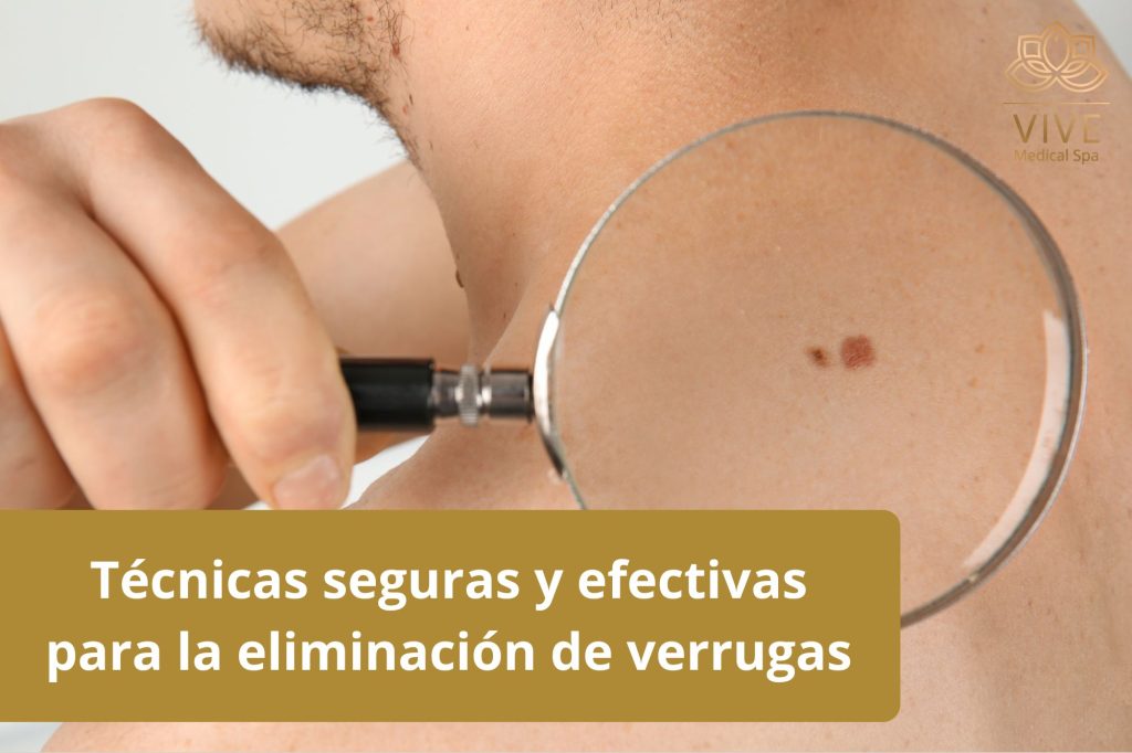 Técnicas seguras y efectivas para la eliminación de verrugas en VIVE Medical Spa Tijuana
