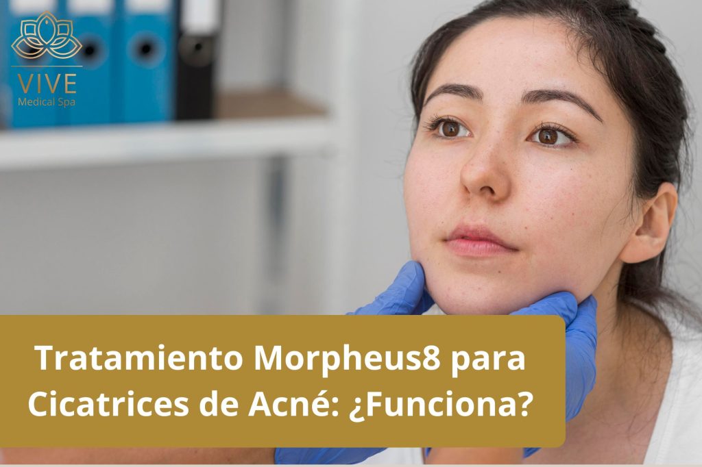 Tratamiento Morpheus8 para cicatrices de acné en VIVE Spa Médico: Rejuvenecimiento facial con radiofrecuencia y microneedling.