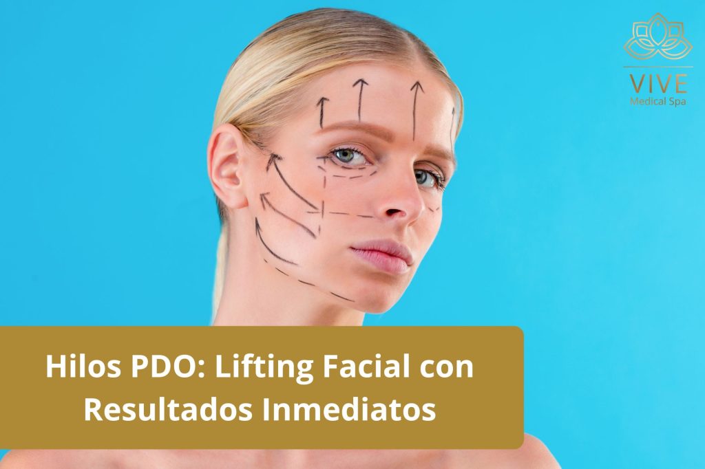 Hilos PDO para lifting facial en VIVE Spa Médico Tijuana - Tratamiento no quirúrgico para reafirmar y rejuvenecer la piel con resultados inmediatos.