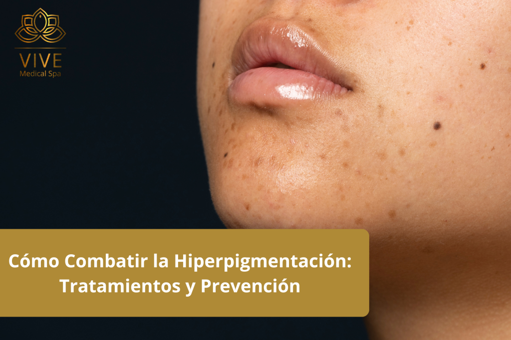 Primer plano de piel con hiperpigmentación en Vive Medical Spa. Descubre tratamientos y consejos de prevención para un tono de piel uniforme.