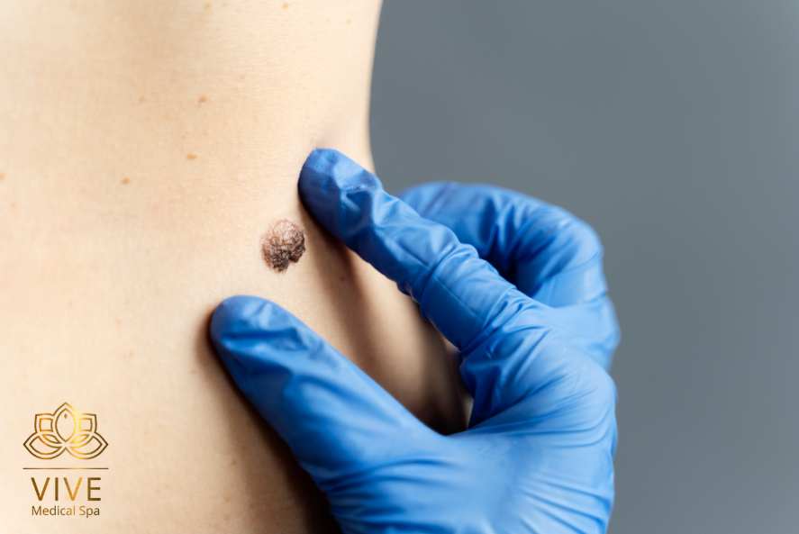 Revisión dermatológica de lunar en VIVE Medical Spa Tijuana